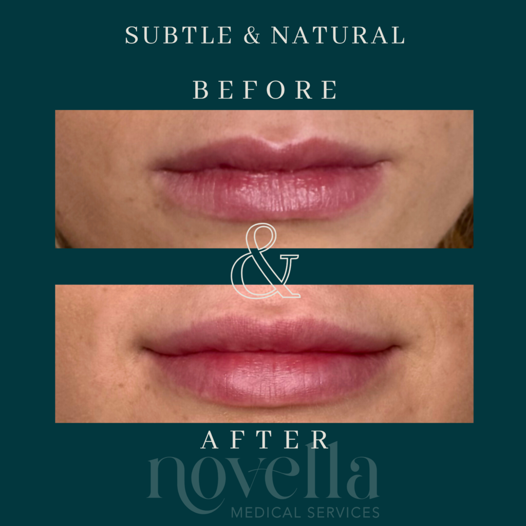 Before and after Subtle and Natural lip filler novella patient