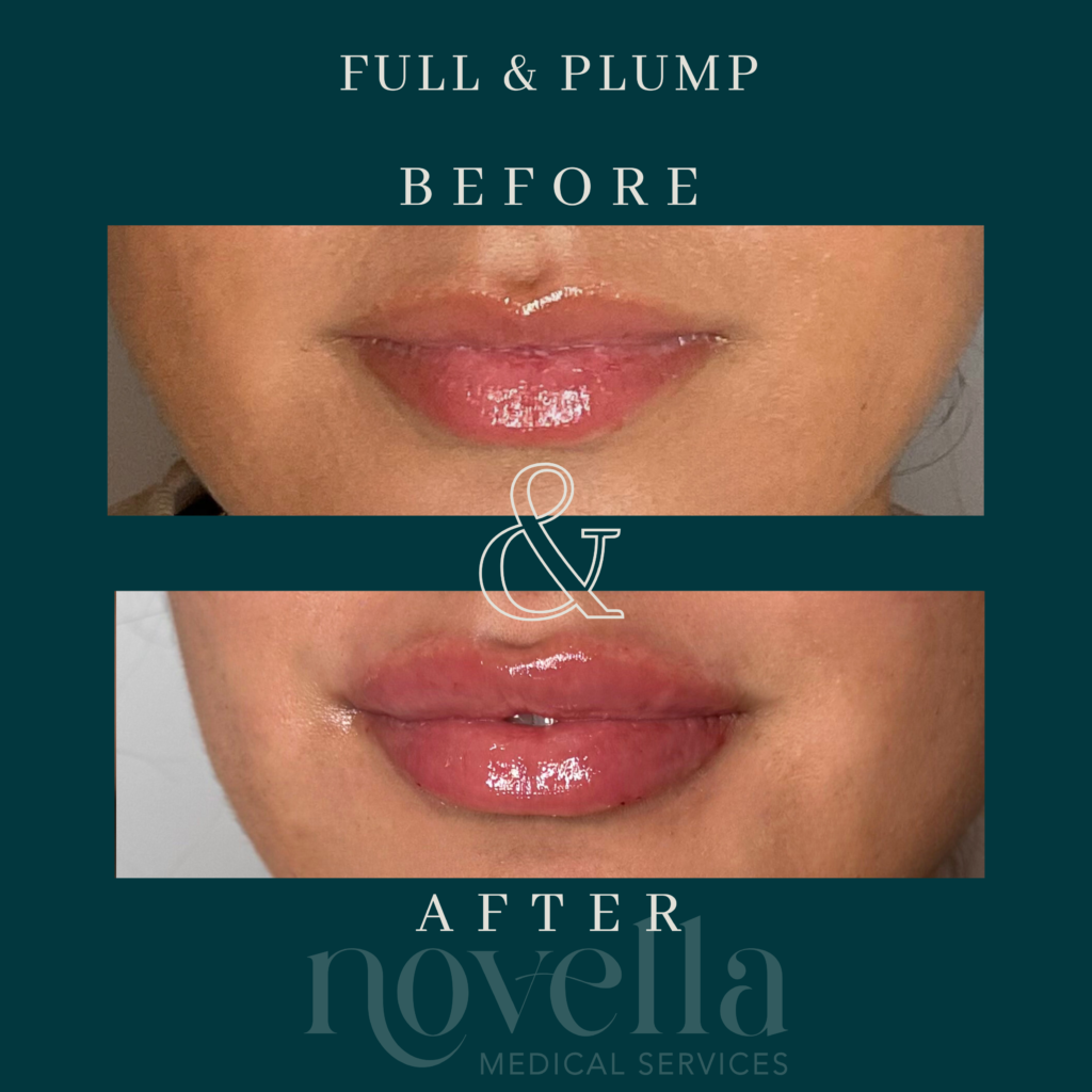 Before and after Full & Plump lip filler novella patient