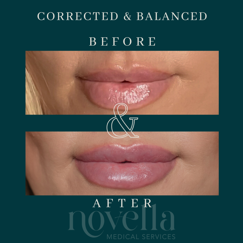 Before and after dissolve lip filler for Balanced & Defined lip filler novella patient